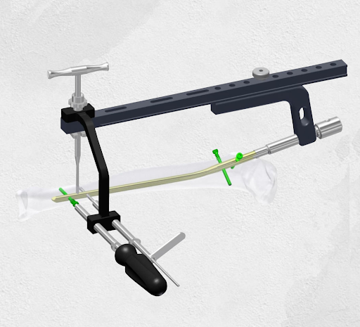ROCKY™ Tibia Nailing System