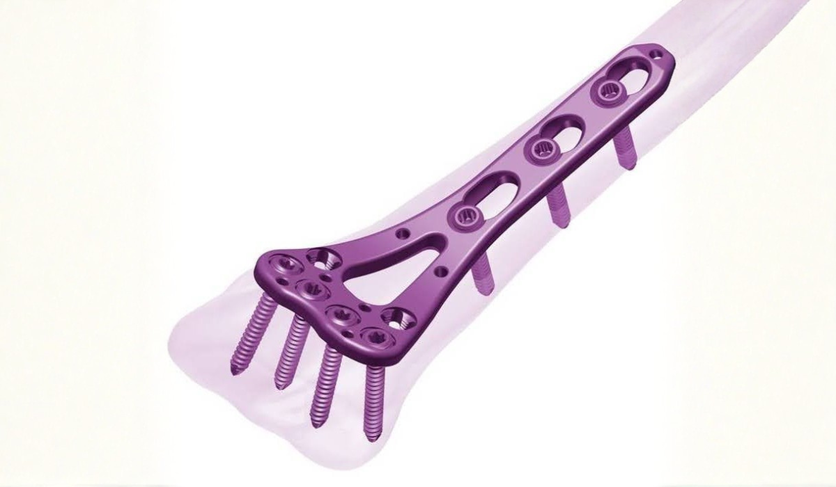 orthopedic locking plates for fracture fixation