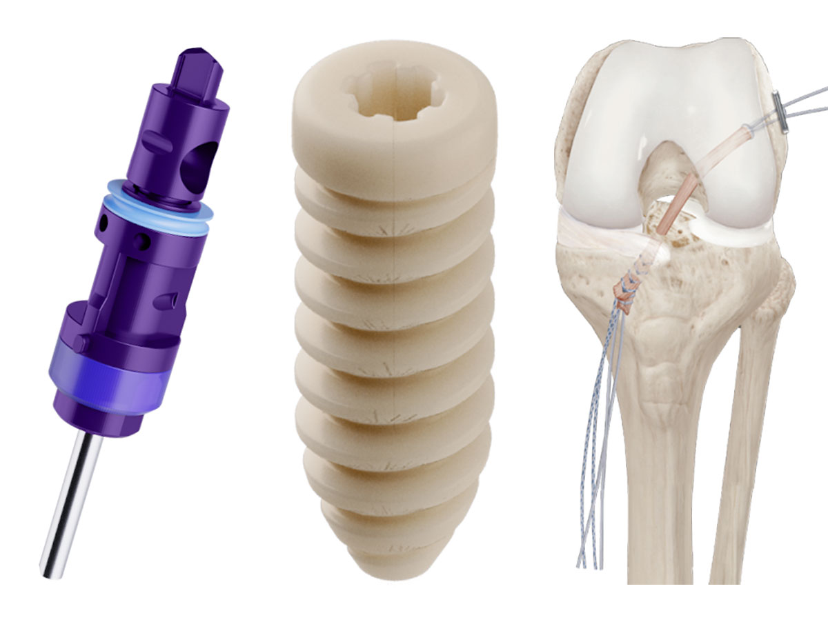 Knee Implants: Enhancing ACL and Meniscus Surgery