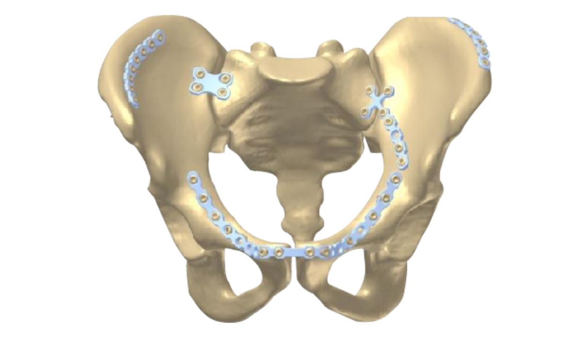 Pre-contoured pelvic plate for complex pelvic fracture fixation
